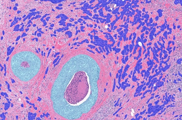 Image: The Aiforia Breast Cancer Grading AI solution is CE-IVD marked (Photo courtesy of Aiforia Technologies)